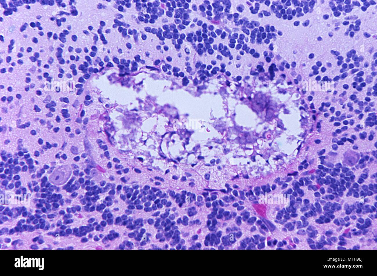 Histopathologic changes found in Tamiami virus encephalitis revealed in a micrograph film, 1972. Image courtesy Centers for Disease Control (CDC) / Dr W Winn. () Stock Photo