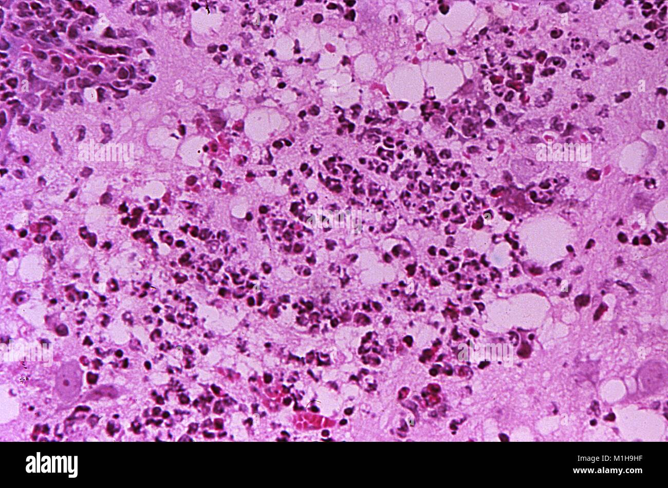 Histopathologic changes found in Tamiami virus encephalitis revealed in a micrograph film, 1972. Image courtesy Centers for Disease Control (CDC) / Dr W Winn. () Stock Photo