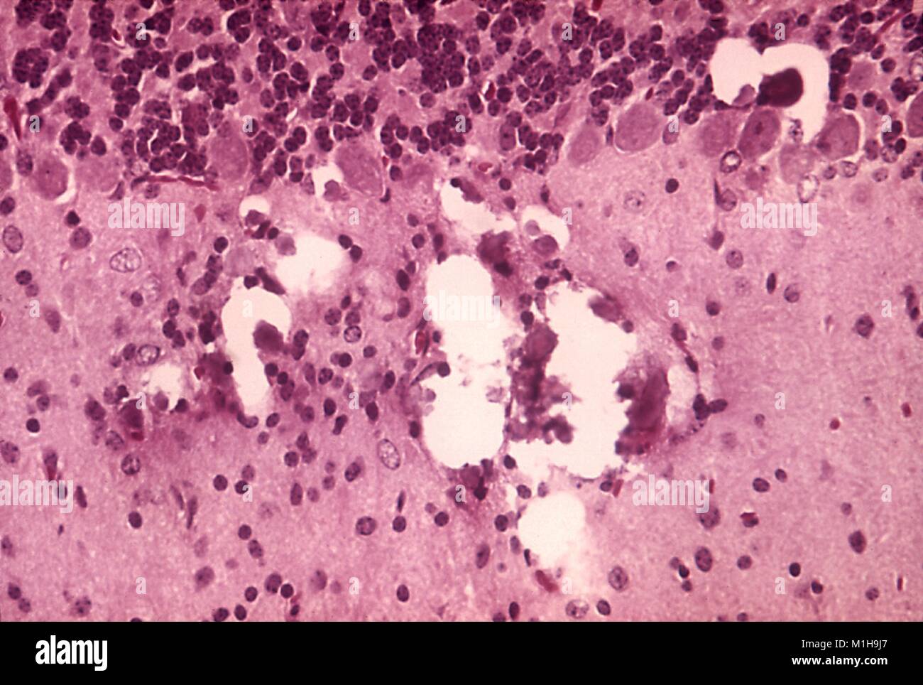 Histopathologic changes found in Tamiami virus encephalitis revealed in a micrograph film, 1972. Image courtesy Centers for Disease Control (CDC) / Dr W Winn. () Stock Photo