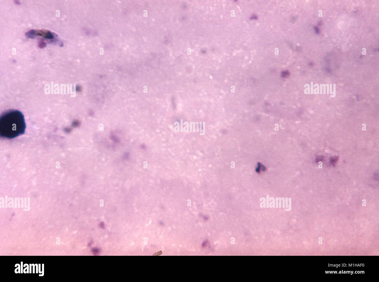 Photomicrograph of a blood sample infected with two species of malariae in different stages of development (Plasmodium falciparum gametocyte and Plasmodium malariae trophozoite), magnified 1125X, on a Giemsa stained slide, 1971. Image courtesy CDC/Dr. Mae Melvin. () Stock Photo
