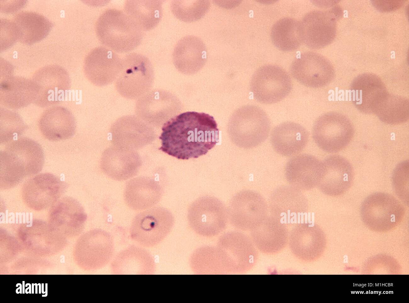 Photomicrograph of the malaria causing parasite Plasmodium Vivax in its macrogametocyte stage, on a blood smear, magnified 1250 times, 1970. Image courtesy CDC. () Stock Photo