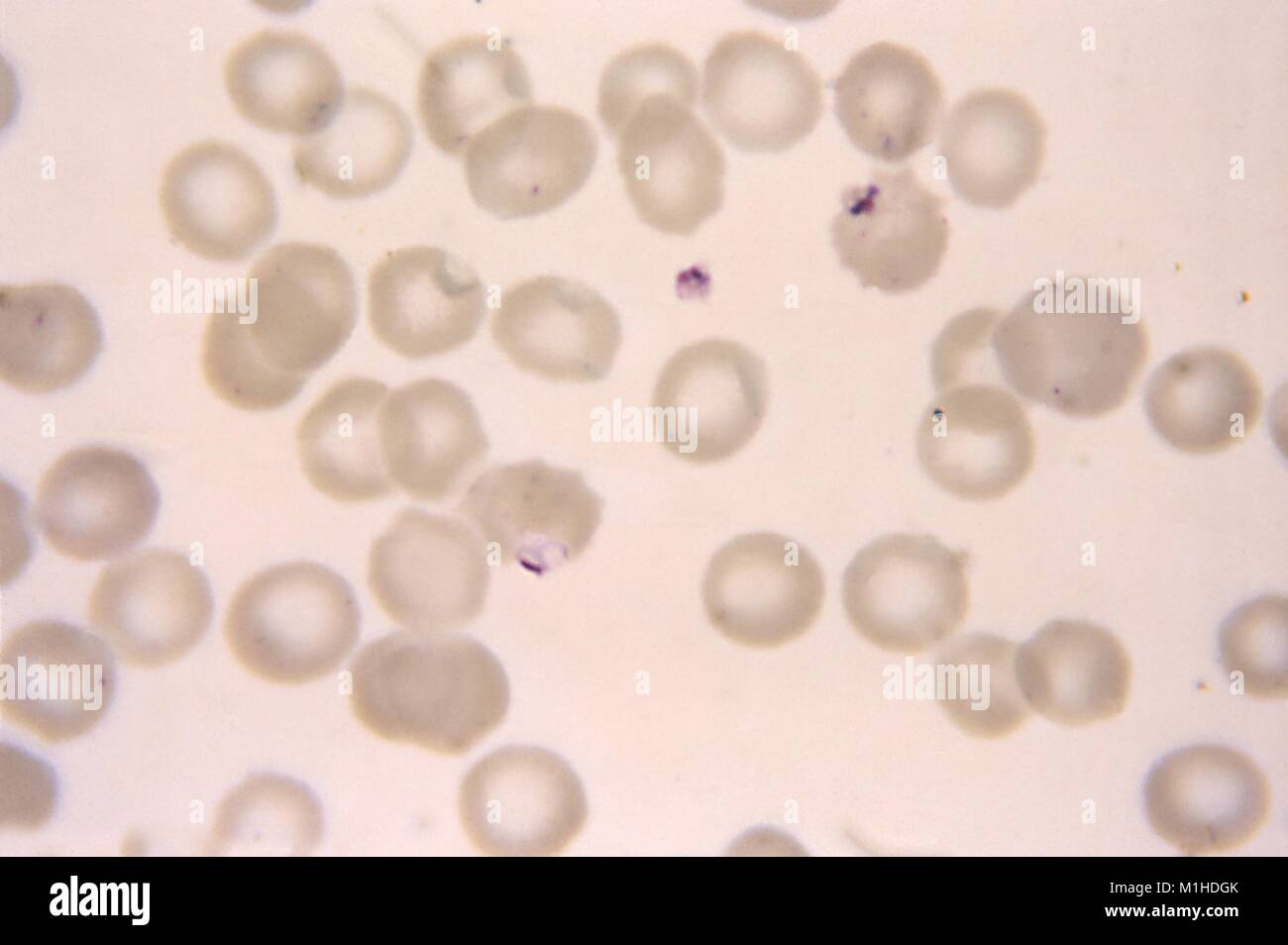 Photomicrograph of the malaria disease manifested in Plasmodium falciparum rings, Maurer's dots and crenated red blood cells, 1966. Image courtesy CDC/Dr. Mae Melvin. () Stock Photo