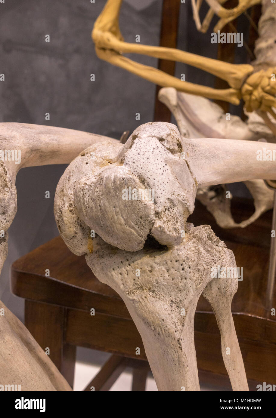 The oleft knee joint of Peter Cluckeys skeleton, who died of chronic rheumatism, National Museum of Health and Medicine, Silver Spring, MD, USA. Stock Photo