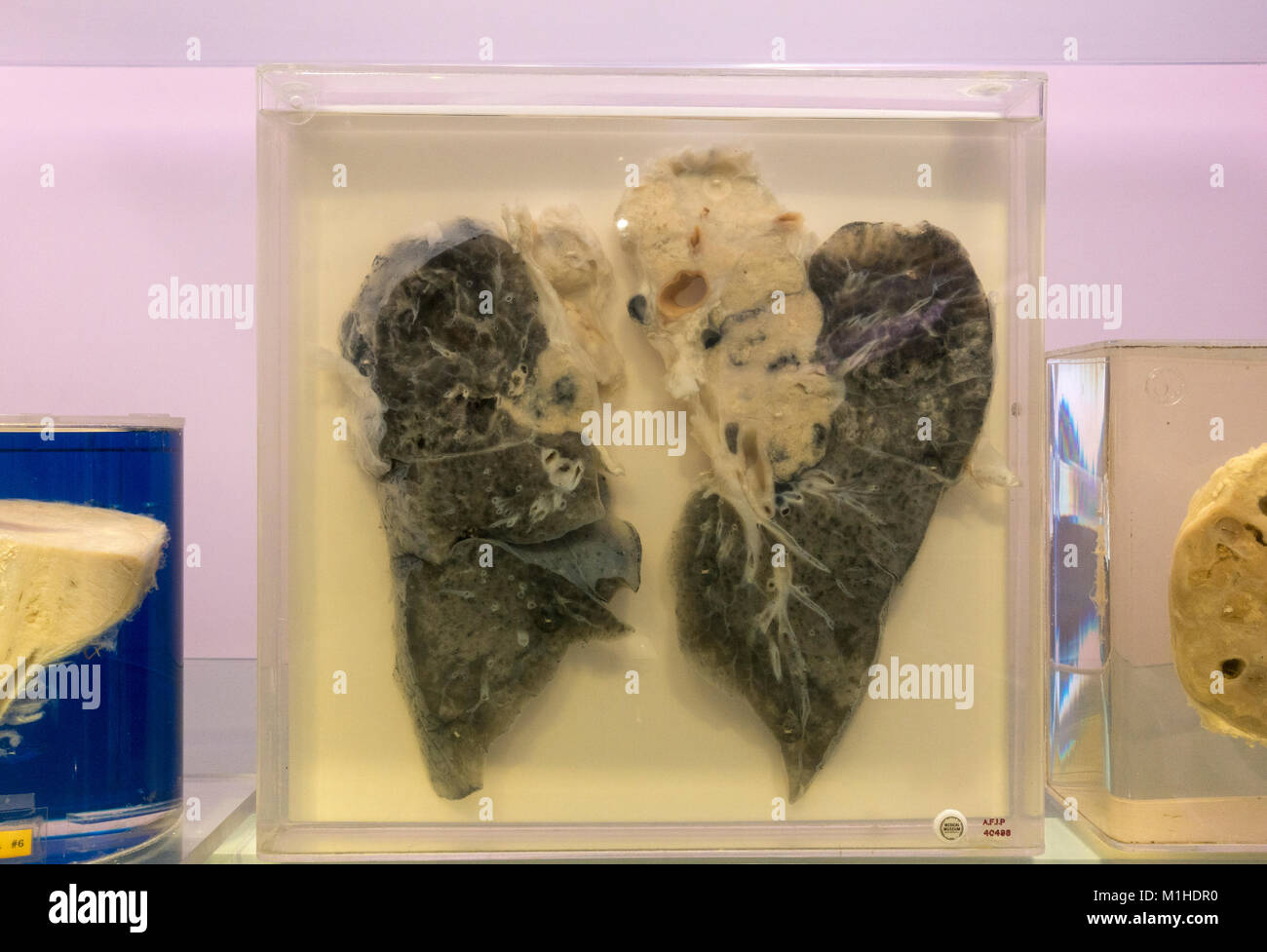 A smokers lungs with carcinoma (cancer) on display in the National Museum of Health and Medicine, Silver Spring, MD, USA. Stock Photo