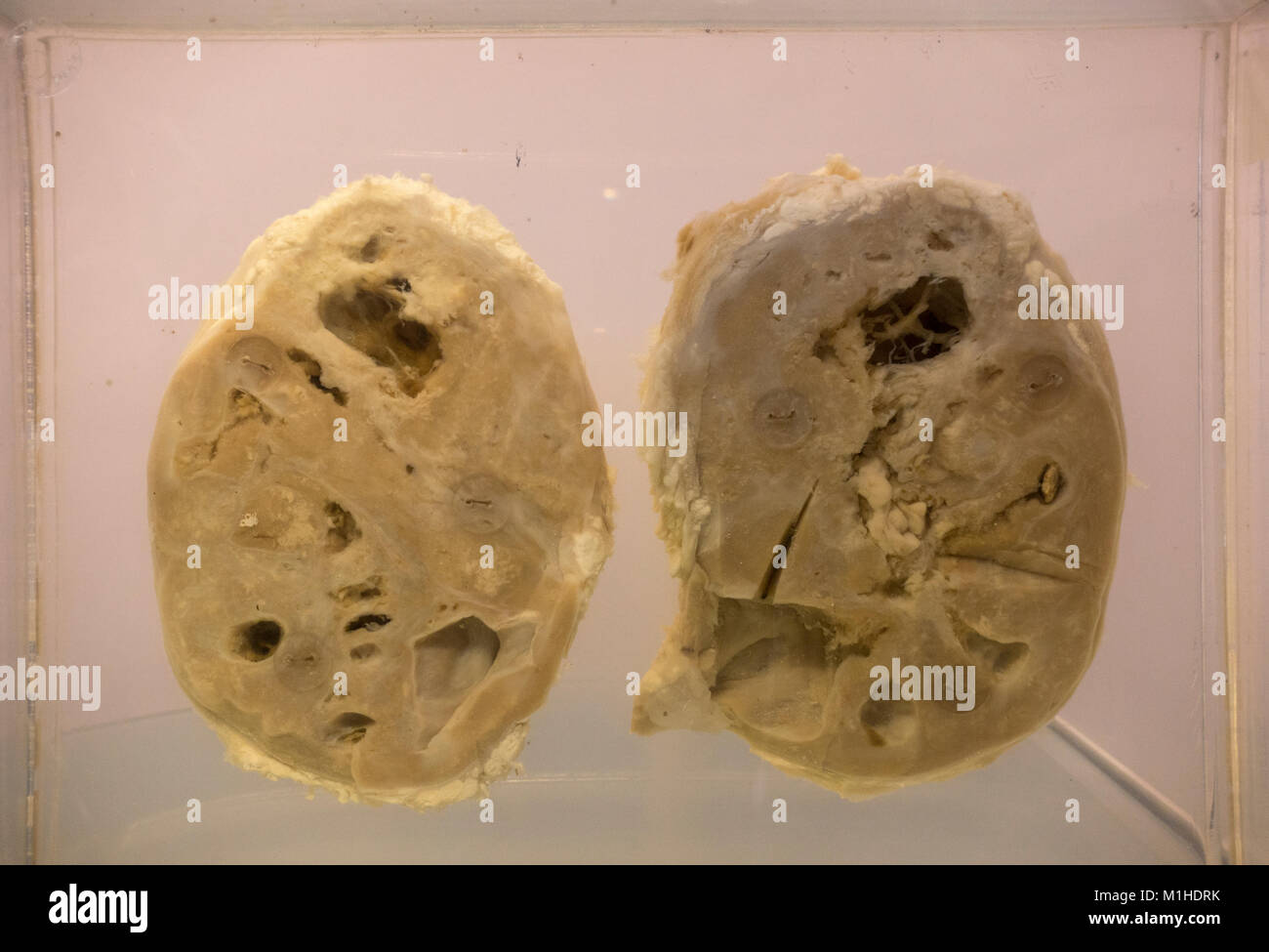 Human kidneys suffering from squamous cell carcinoma on display in the National Museum of Health and Medicine, Silver Spring, MD, USA. Stock Photo