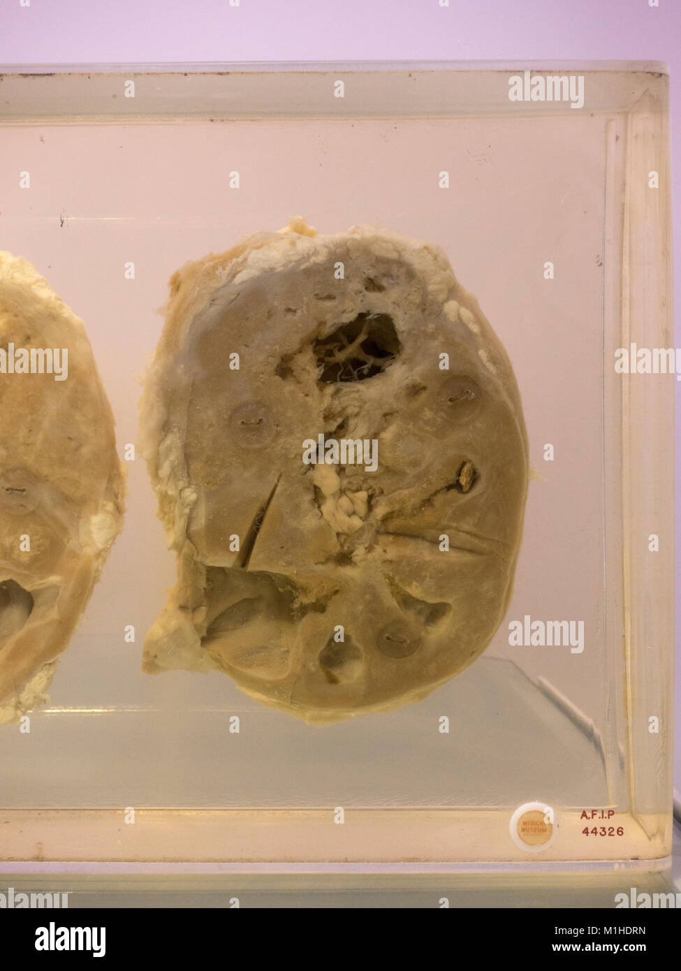 A human kidney suffering from squamous cell carcinoma on display in the National Museum of Health and Medicine, Silver Spring, MD, USA. Stock Photo