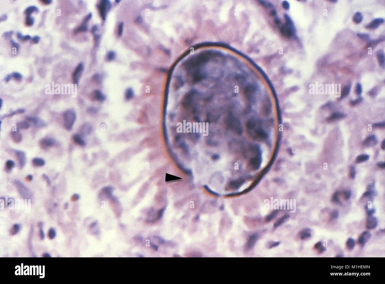 Schistosoma japonicum egg vestigial spine revealed in the micrograph film, taken from a liver tissue biopsy, 1986. Image courtesy Centers for Disease Control (CDC). () Stock Photo