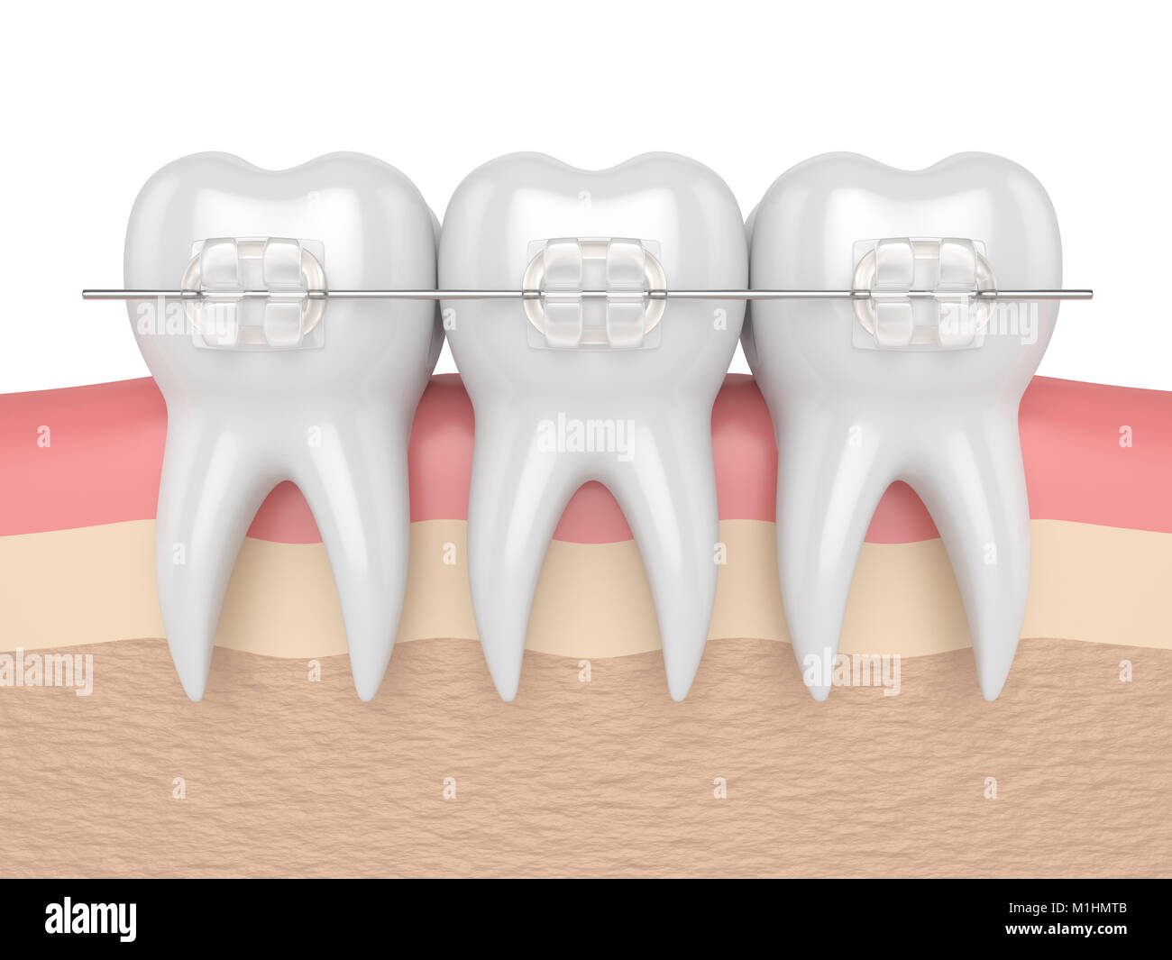 3d render of teeth with ceramic clear braces in gums Stock Photo - Alamy
