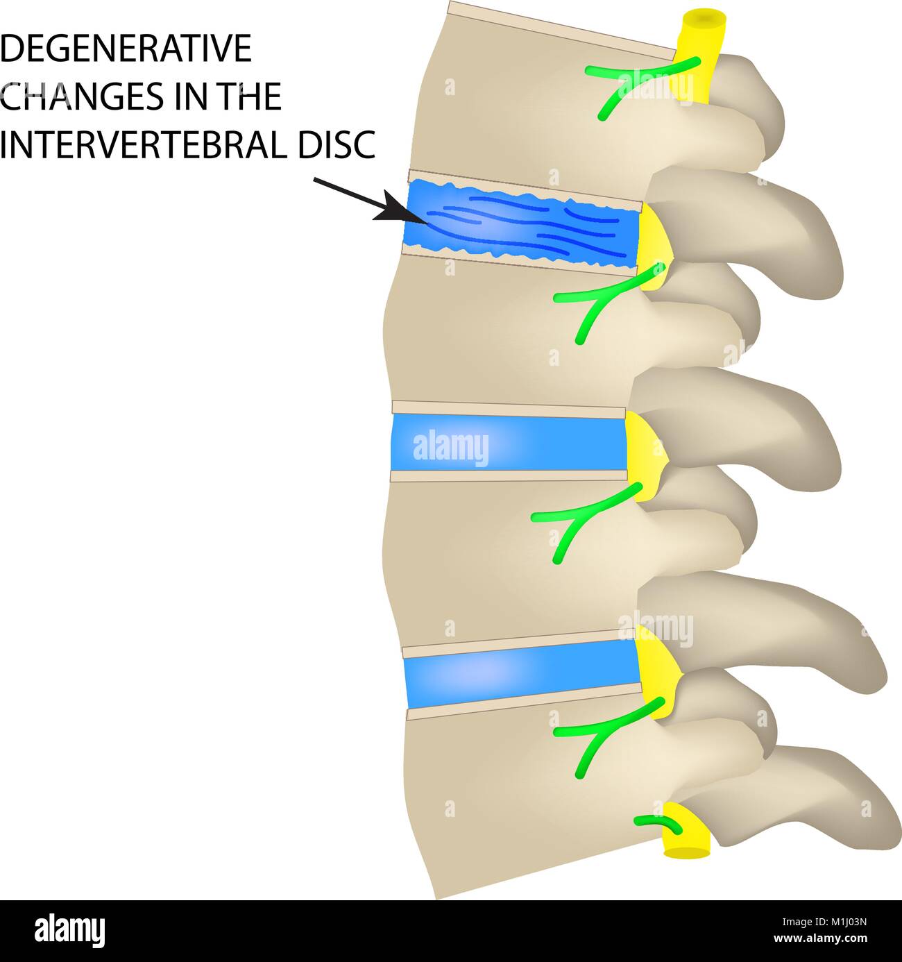 Degenerative changes in the intervertebral disc. Vector illustration on isolated background. Stock Vector