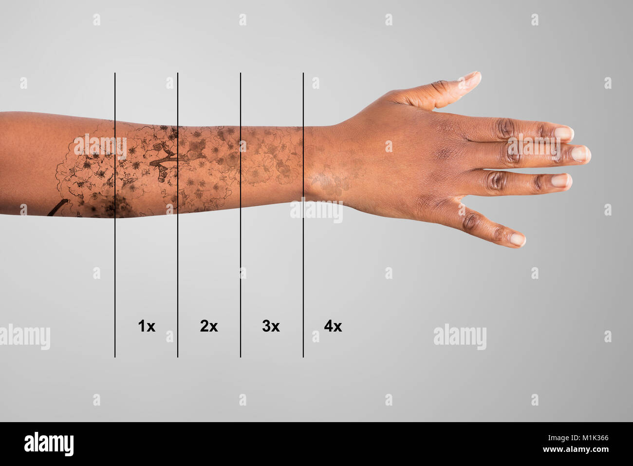 Laser Tattoo Removal On Woman's Hand Against Grey Background Stock