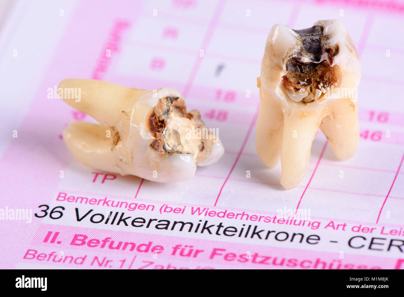 Heil- und Kostenplan für Zahnersatz mit extrhiertem Backenzahn Stock Photo