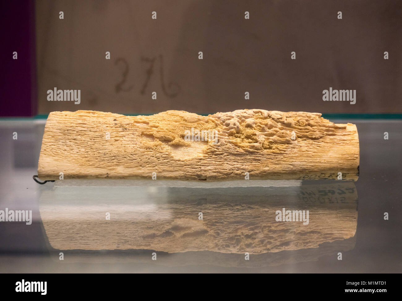 A human tibia with osteomyelitis on display in the National Museum of Health and Medicine, Silver Spring, MD, USA. Stock Photo