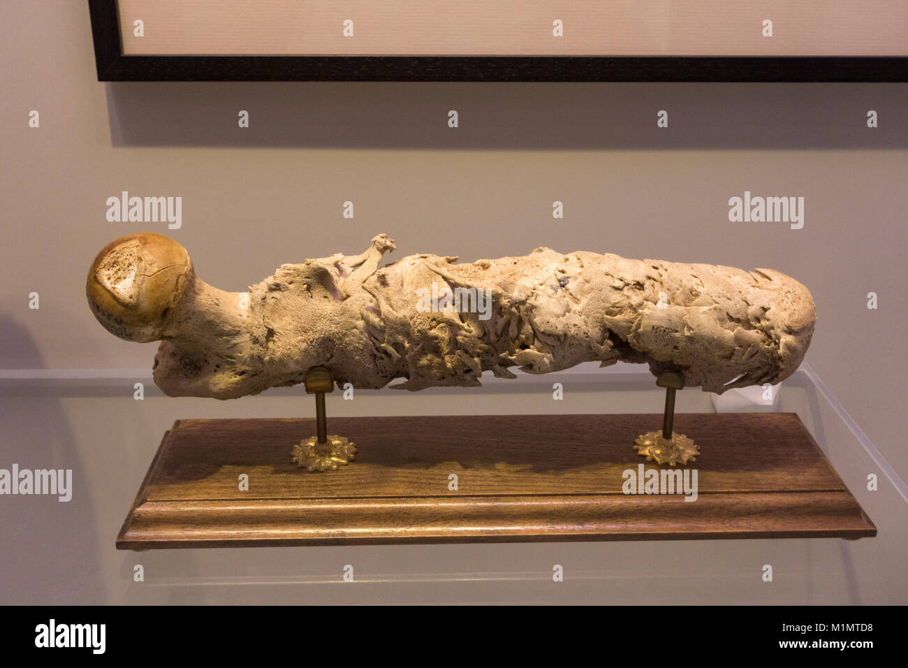 A human femur with gunshot wound (chronic osteomyelitis) on display in the National Museum of Health and Medicine, Silver Spring, MD, USA. Stock Photo