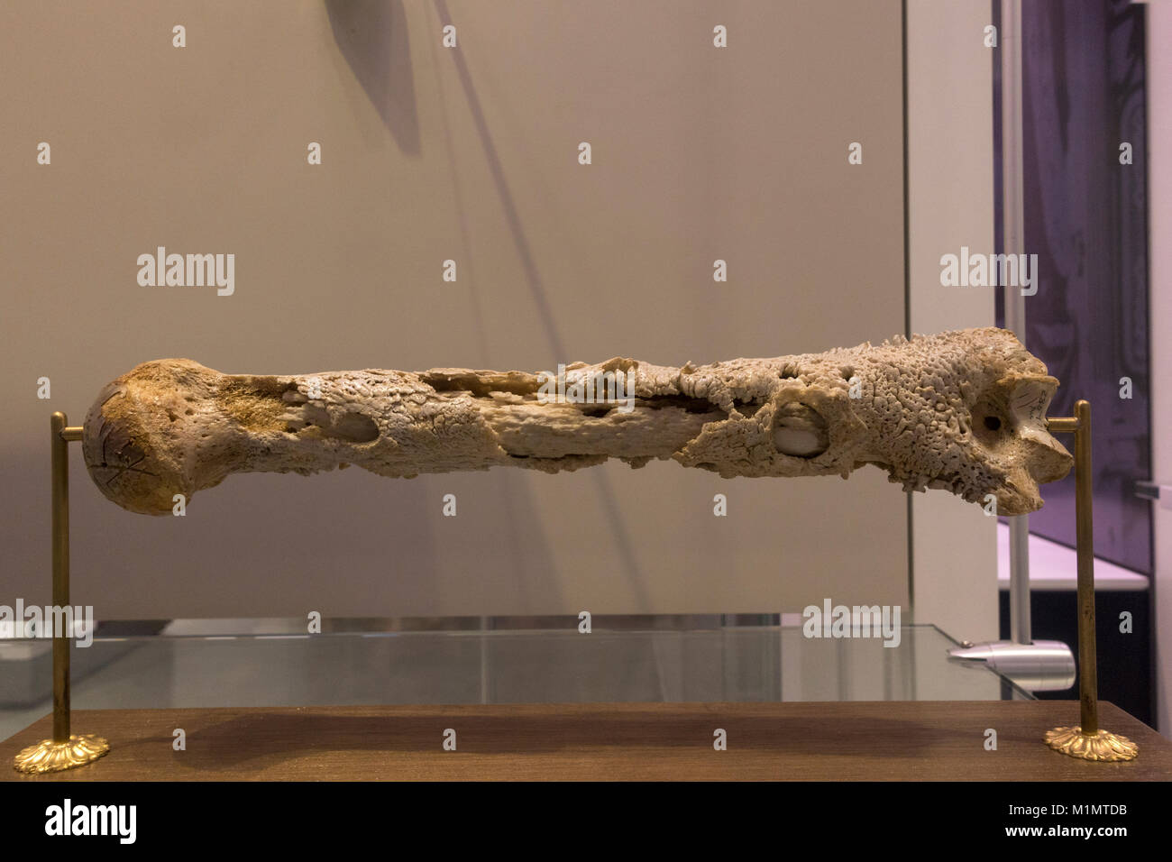 A human humerus with gunshot wound following infection on display in the National Museum of Health and Medicine, Silver Spring, MD, USA. Stock Photo