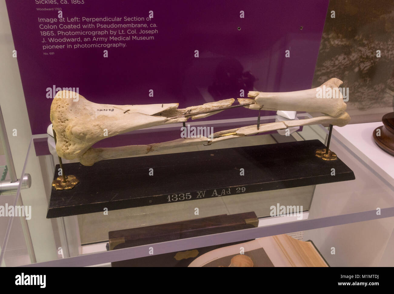 Tibia & fibula of Maj. Gen Daniel E. Sickles on display in the National Museum of Health and Medicine, Silver Spring, MD, USA. Stock Photo