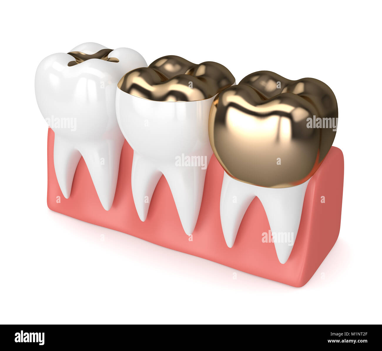 3d render of teeth with different types of dental gold filling in gums