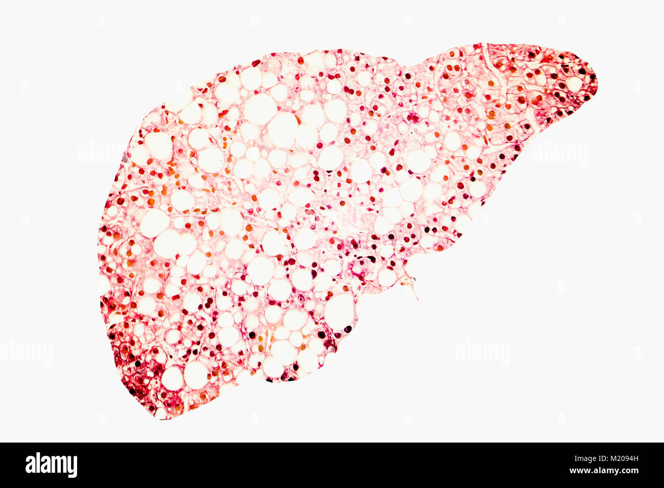 Fatty liver, conceptual illustration. Fatty liver is commonly associated with alcohol or metabolic syndrome (diabetes, hypertension and obesity), but can also be due to any one of many causes. Fatty liver disease is a reversible condition wherein large vacuoles of fat (pale yellow circles) accumulate in liver cells. Stock Photo