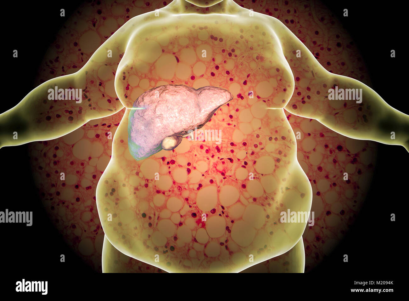 Fatty liver in obese person, conceptual illustration. Fatty liver is commonly associated with alcohol or metabolic syndrome (diabetes, hypertension and obesity), but can also be due to any one of many causes. Fatty liver disease is a reversible condition wherein large vacuoles of fat (pale yellow circles) accumulate in liver cells. Stock Photo