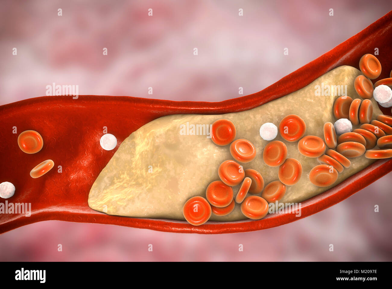Atheromatous plaque inside blood vessel, computer illustration. A cholesterol atheroma is causing a narrowing of an artery (atherosclerosis). Stock Photo