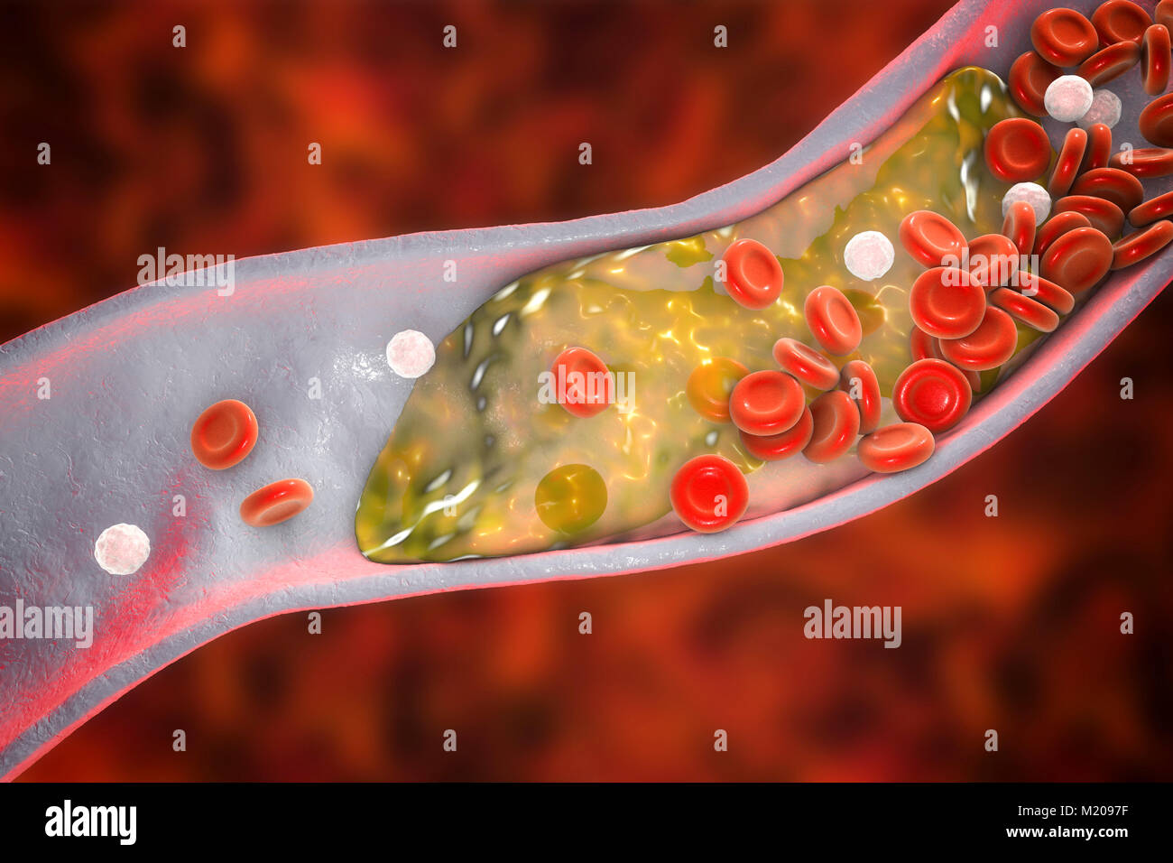 Atheromatous plaque inside blood vessel, computer illustration. A cholesterol atheroma is causing a narrowing of an artery (atherosclerosis). Stock Photo