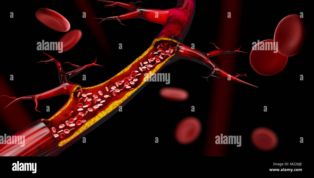 3d illustration of Blocked blood vessel - artery with cholesterol ...