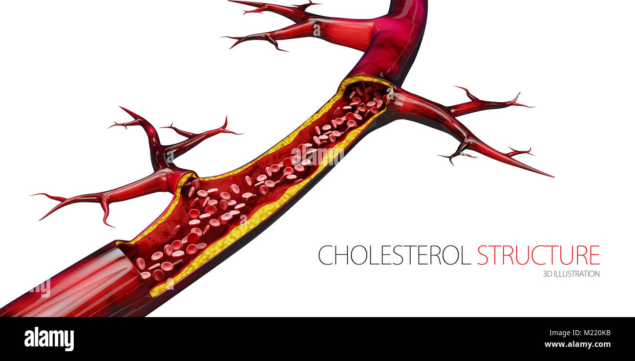 Blocked blood vessel - artery with cholesterol buildup realistic 3d ...