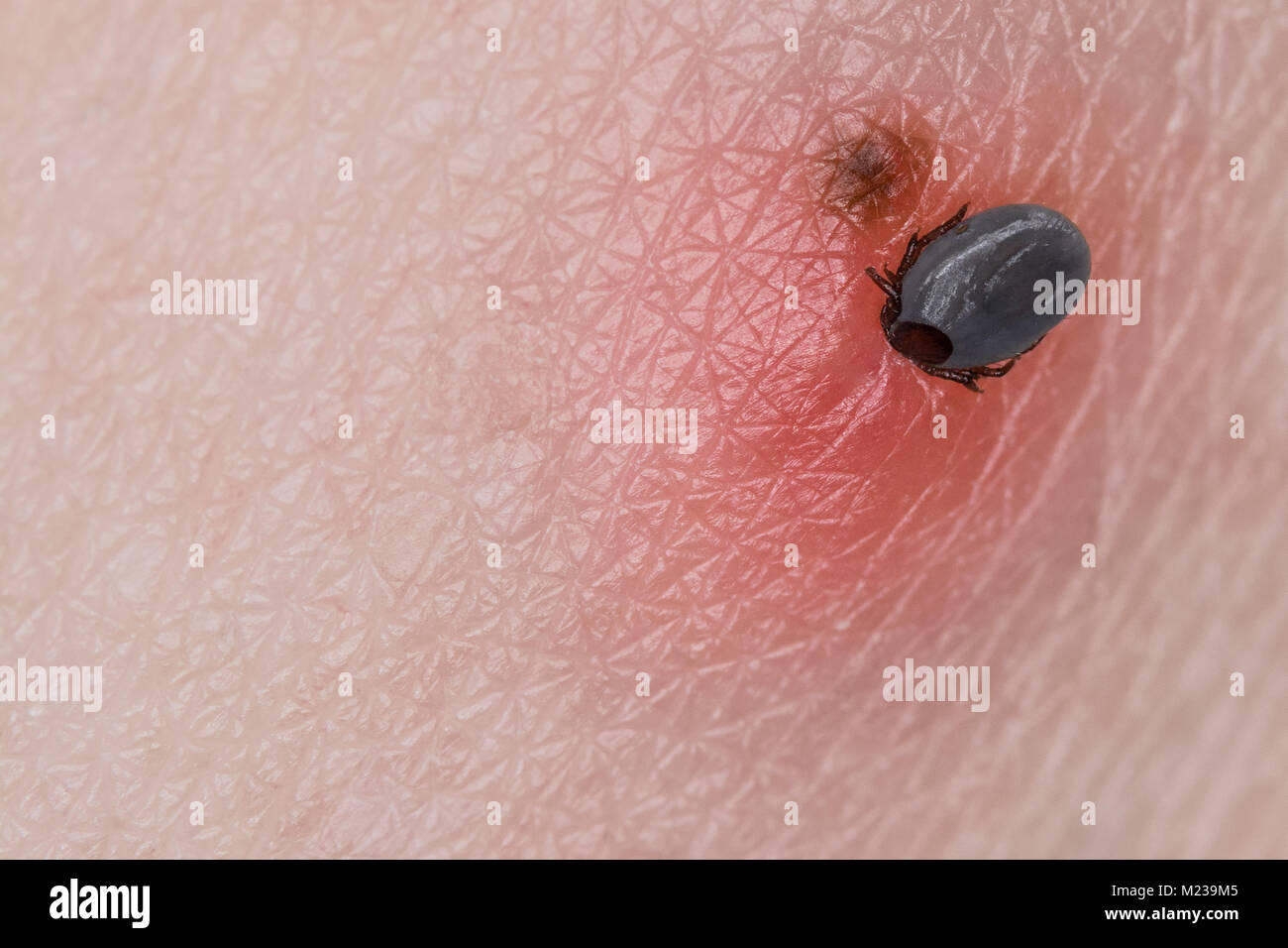 Tick and freckle. Ixodes ricinus. Close-up of small parasitic mite when sucking blood on human skin with the birthmark. Encephalitis, Lyme disease. Stock Photo