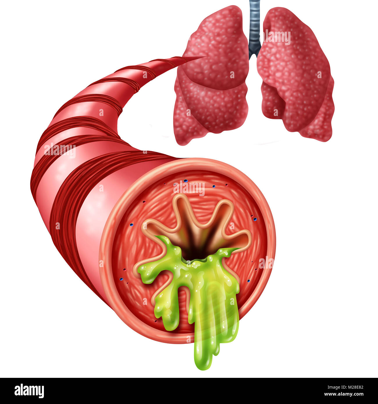 Bronchitis anatomy concept as an inflammation of bronchial tube lining with thick mucus secreted as a chest cold as a 3D illustration elements. Stock Photo