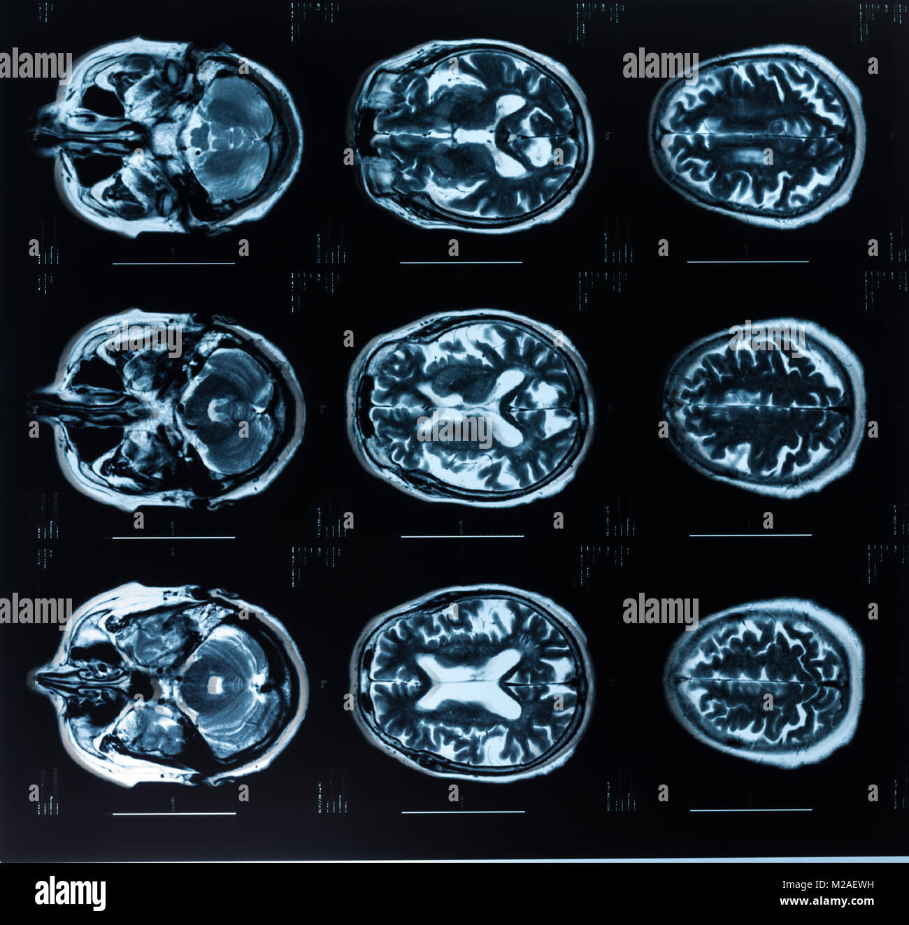 Head MRT. MR image of human brain Stock Photo