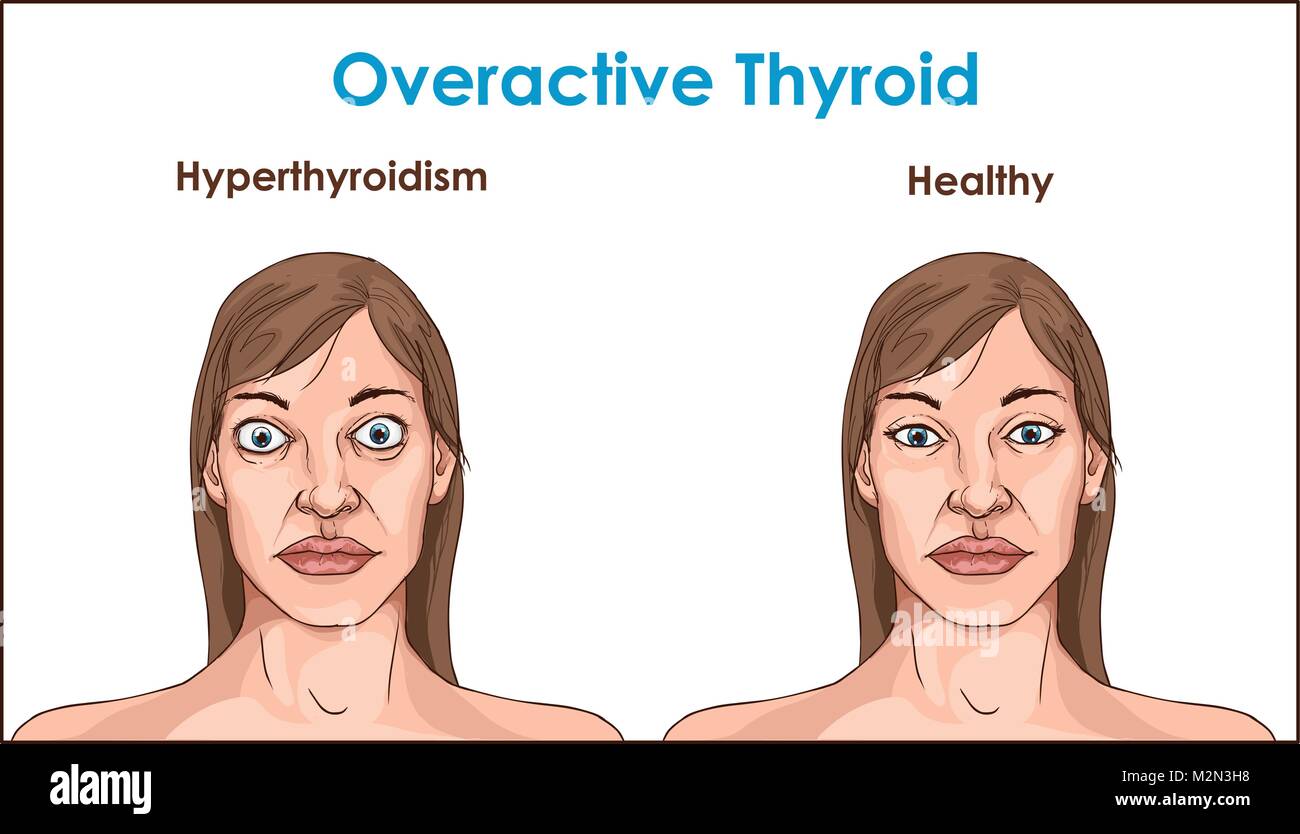 щитовидка симптомы у женщин признаки фото