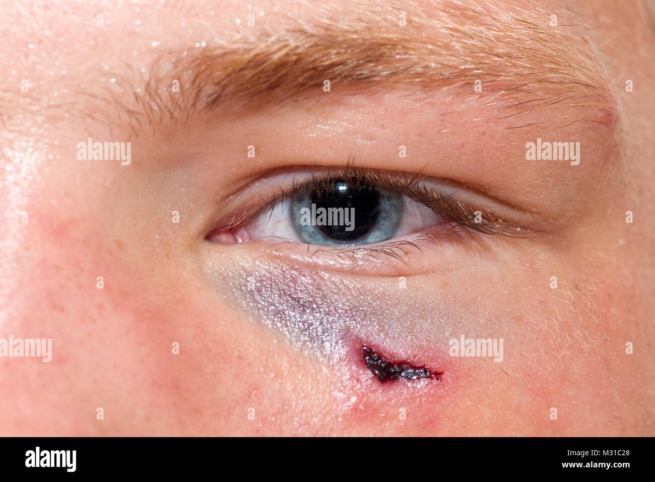 Blutung im Lidbereich des Auges ( Feilchen ) Stock Photo