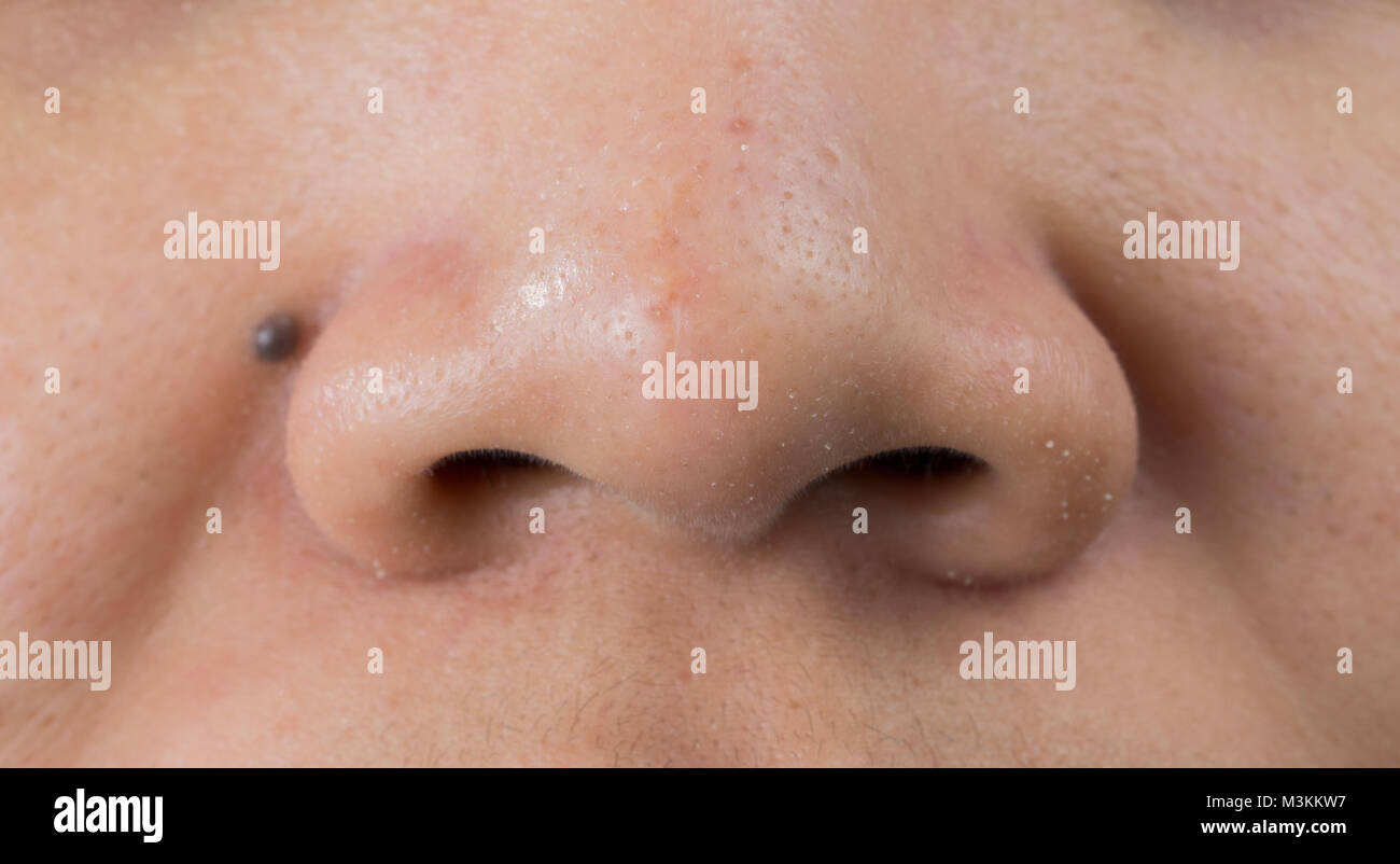 Blackheads acne on Asian woman nose. Scar on tip of nose. Open comedones and large pores skin need AHA, BHA or benzoyl peroxide for treatment. Stock Photo