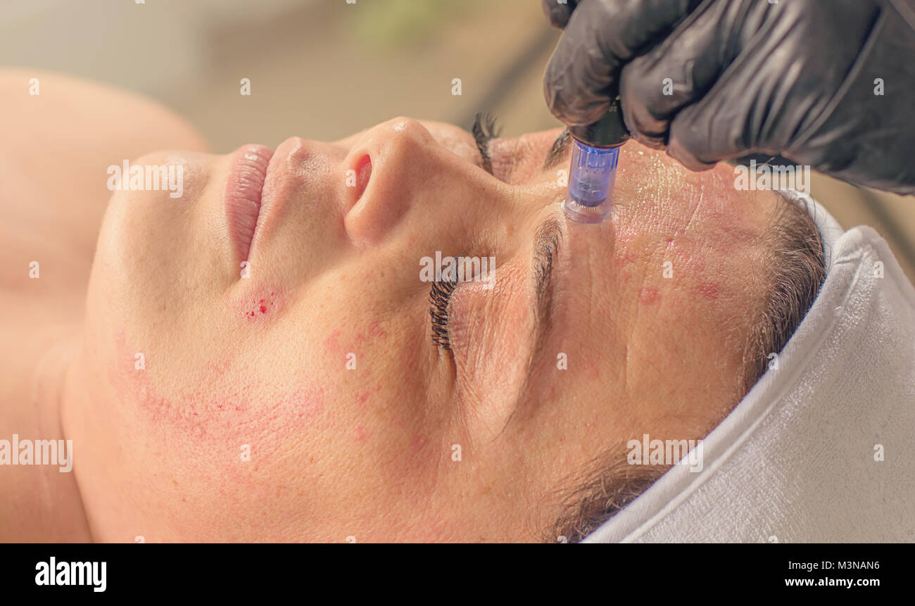 Needle mesotherapy treatment on a woman face. Stock Photo