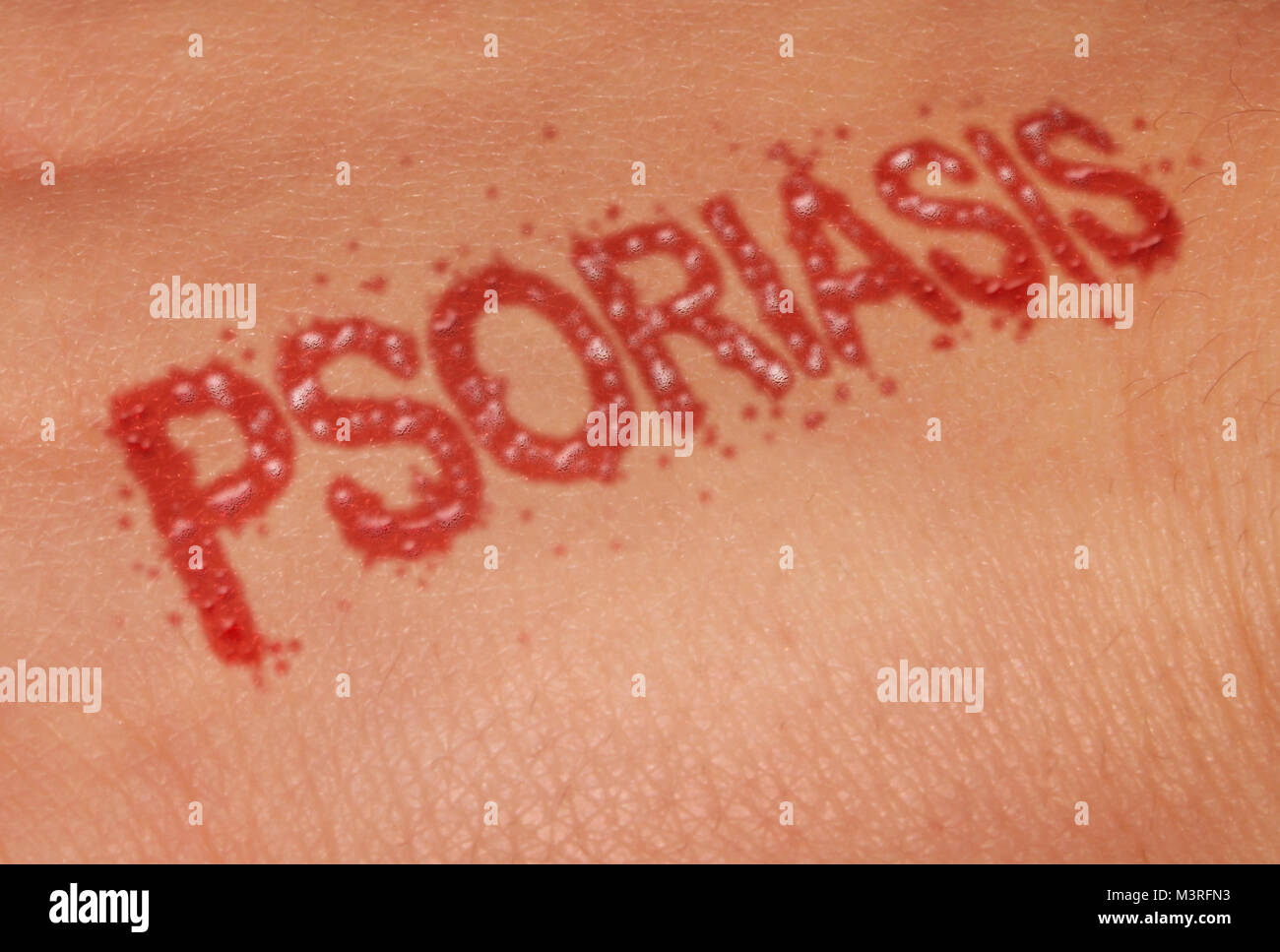 Psoriasis autoimmune disease as dry red skin patches as a symbol for dermatology illness in a 3D illustration style. Stock Photo