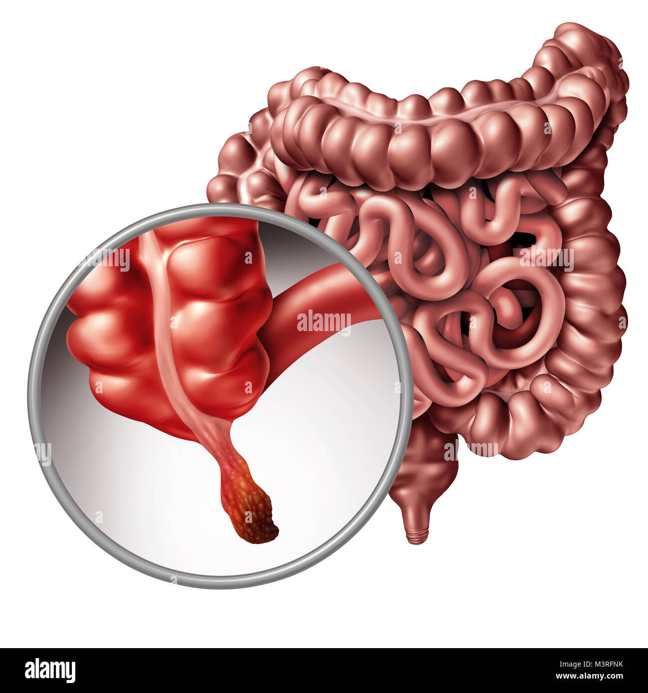 Appendicitis and appendix inflammation disease concept as a close up of human intestine anatomy as a 3D illustration. Stock Photo