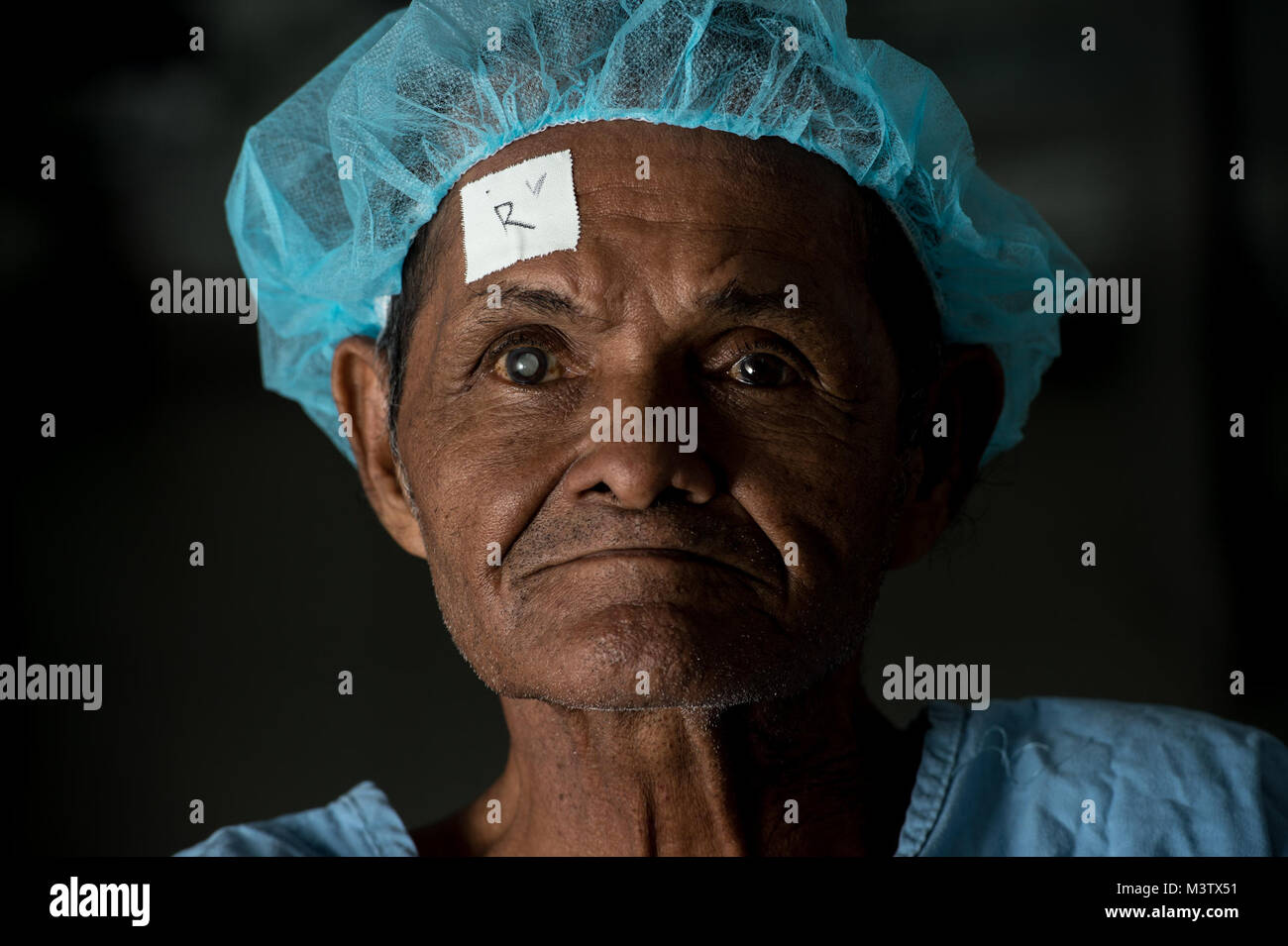 Pedro Gonzalez, age 71, waits for his extracapsular cataract extraction with intraocular implant surgery at the Centro Hospitalario Luis 'Chicho' Fabrega, Santiago, Panama, Feb. 6, 2017, during a medical readiness training exercise. A U.S. military medical team was in Panama to help treat individuals with cataracts that otherwise would have gone untreated. Medical readiness training exercises provide U.S. military personnel training in delivery of medical care in austere conditions, promote diplomatic relations between the U.S. and host nations in Central America and provide humanitarian and c Stock Photo