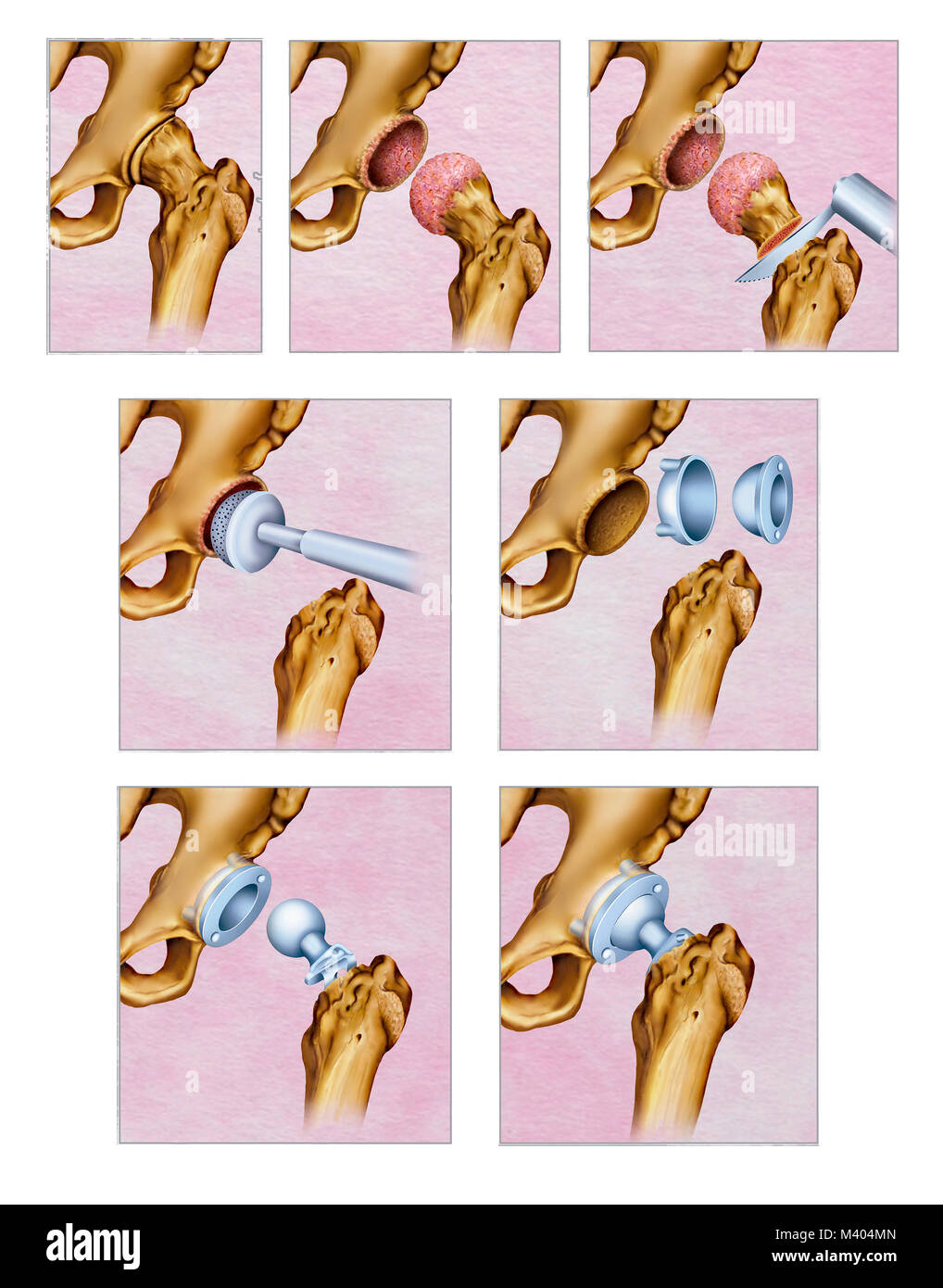 Ilustración sobre el tratamiento quirúrgico por artrosis en la articulación de la cadera. La artrosis de cadera es el desgaste del cartílago de la art Stock Photo