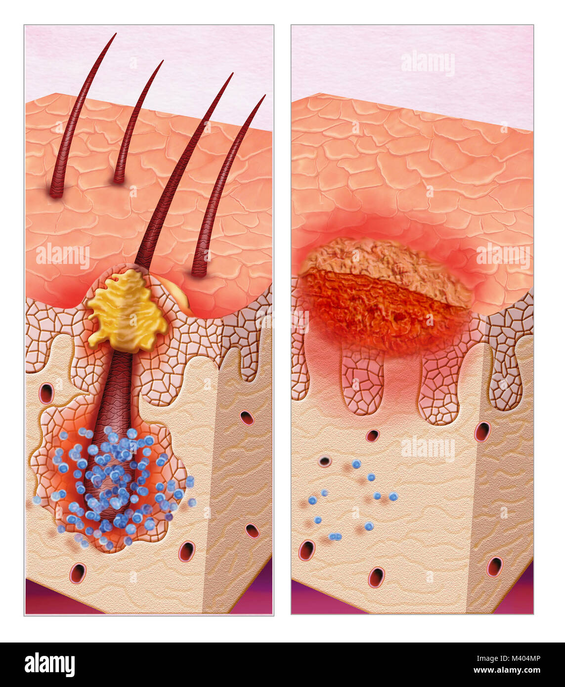 Illustration about skin infections Stock Photo