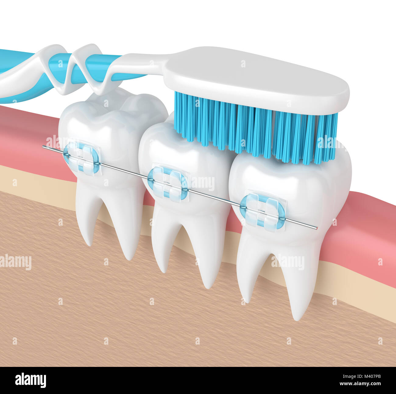 3d render of teeth with ceramic braces and toothbrush in gums Stock ...