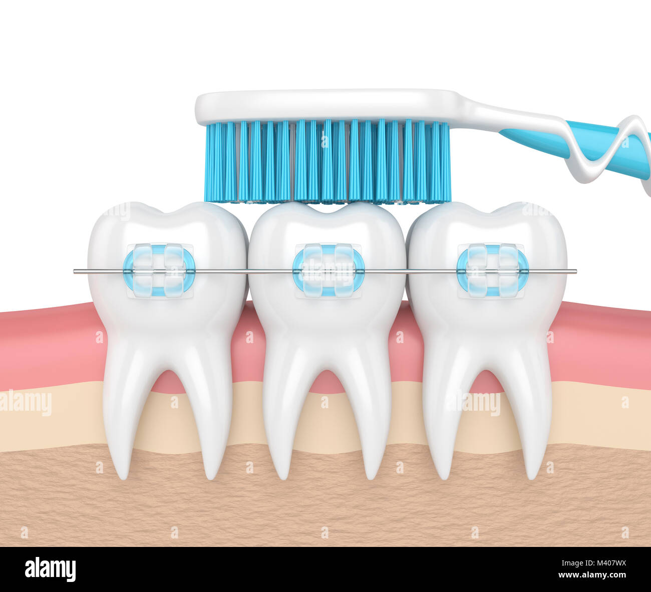 3d render of teeth with ceramic braces and toothbrush in gums Stock ...