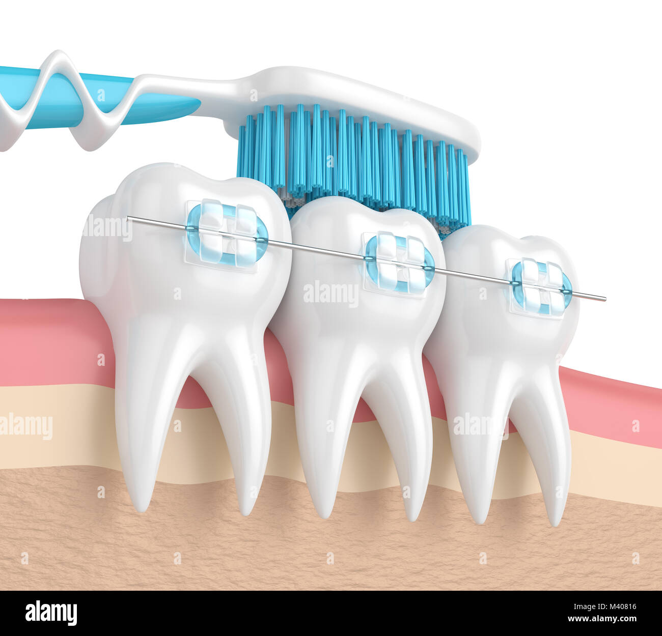 3d render of teeth with ceramic braces and toothbrush in gums Stock ...