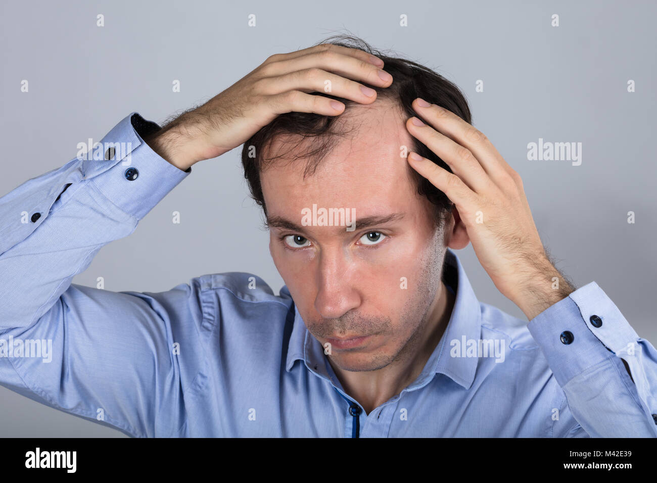 Man Suffering From Hair Loss Against Grey Background Stock Photo