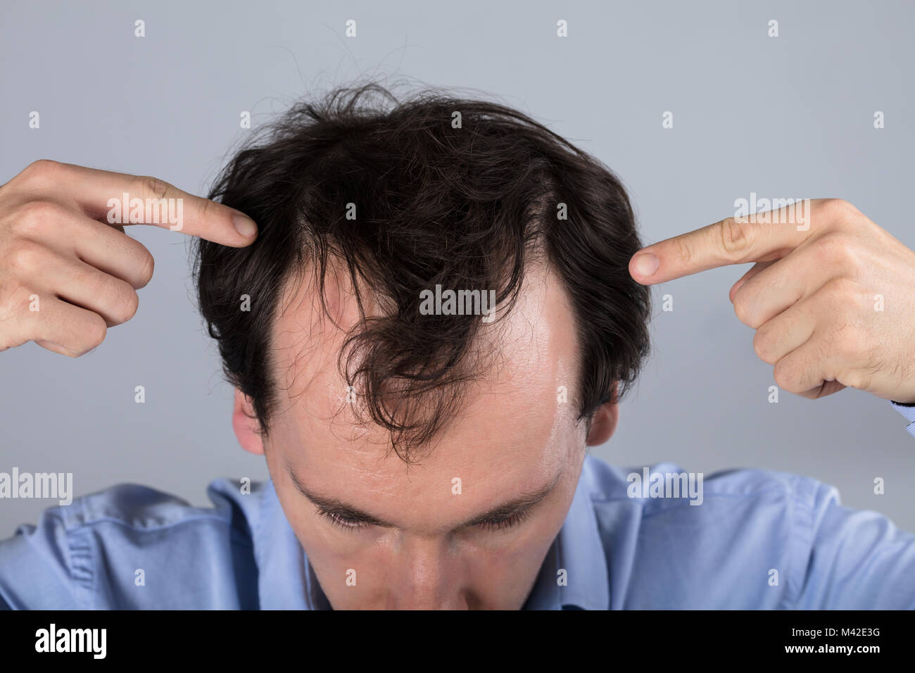 Close-up Of A Man's Head With Hair Loss Symptoms Stock Photo