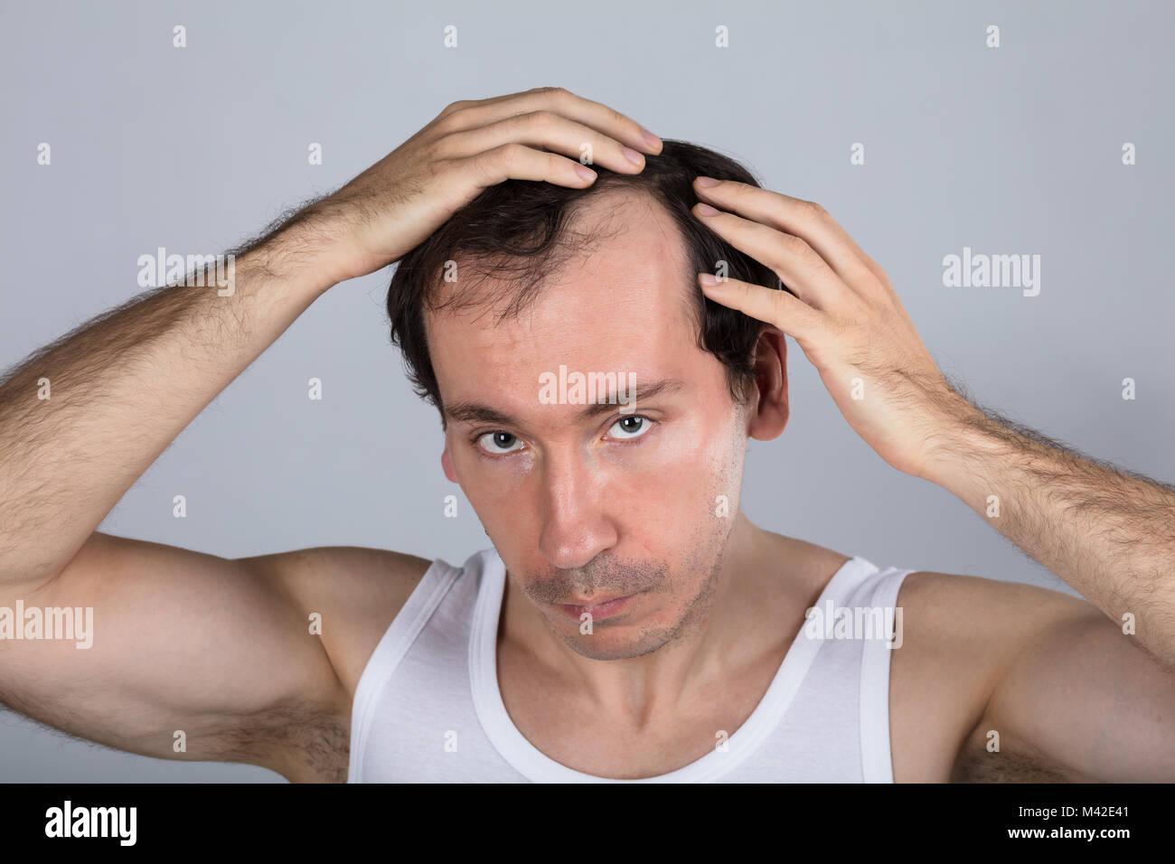 Man Suffering From Hair Loss Against Grey Background Stock Photo
