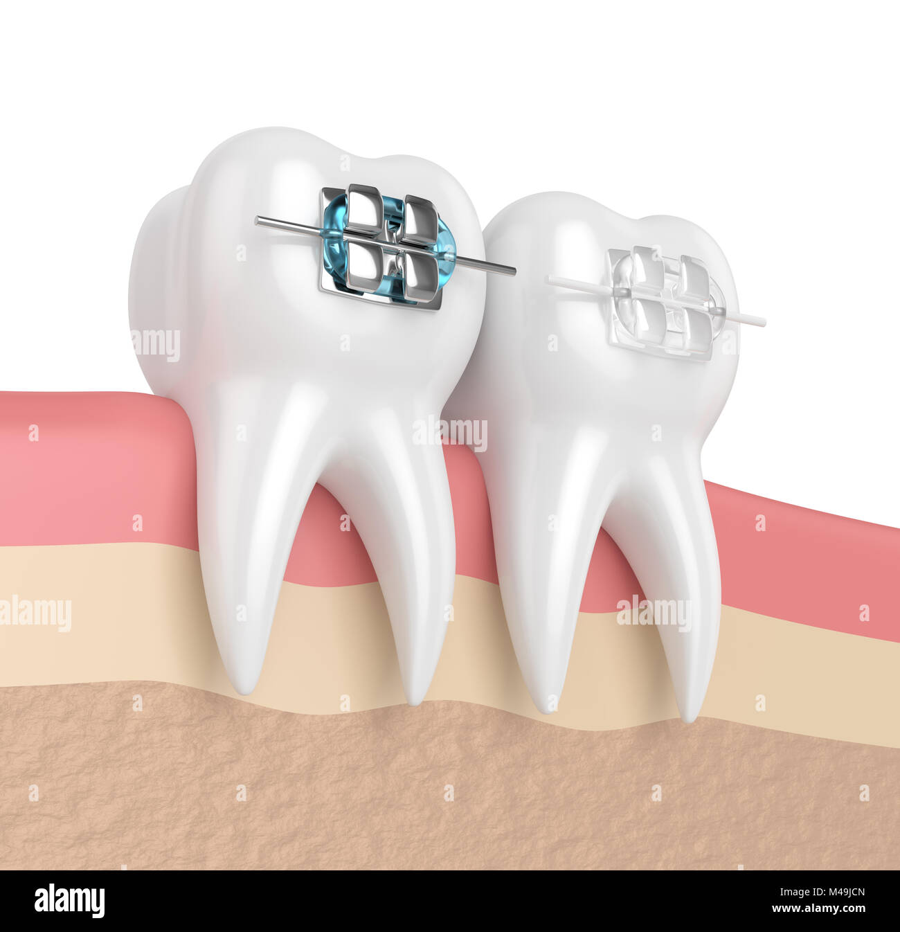 3d render of teeth with ceramic and metal braces in gums. The concept ...
