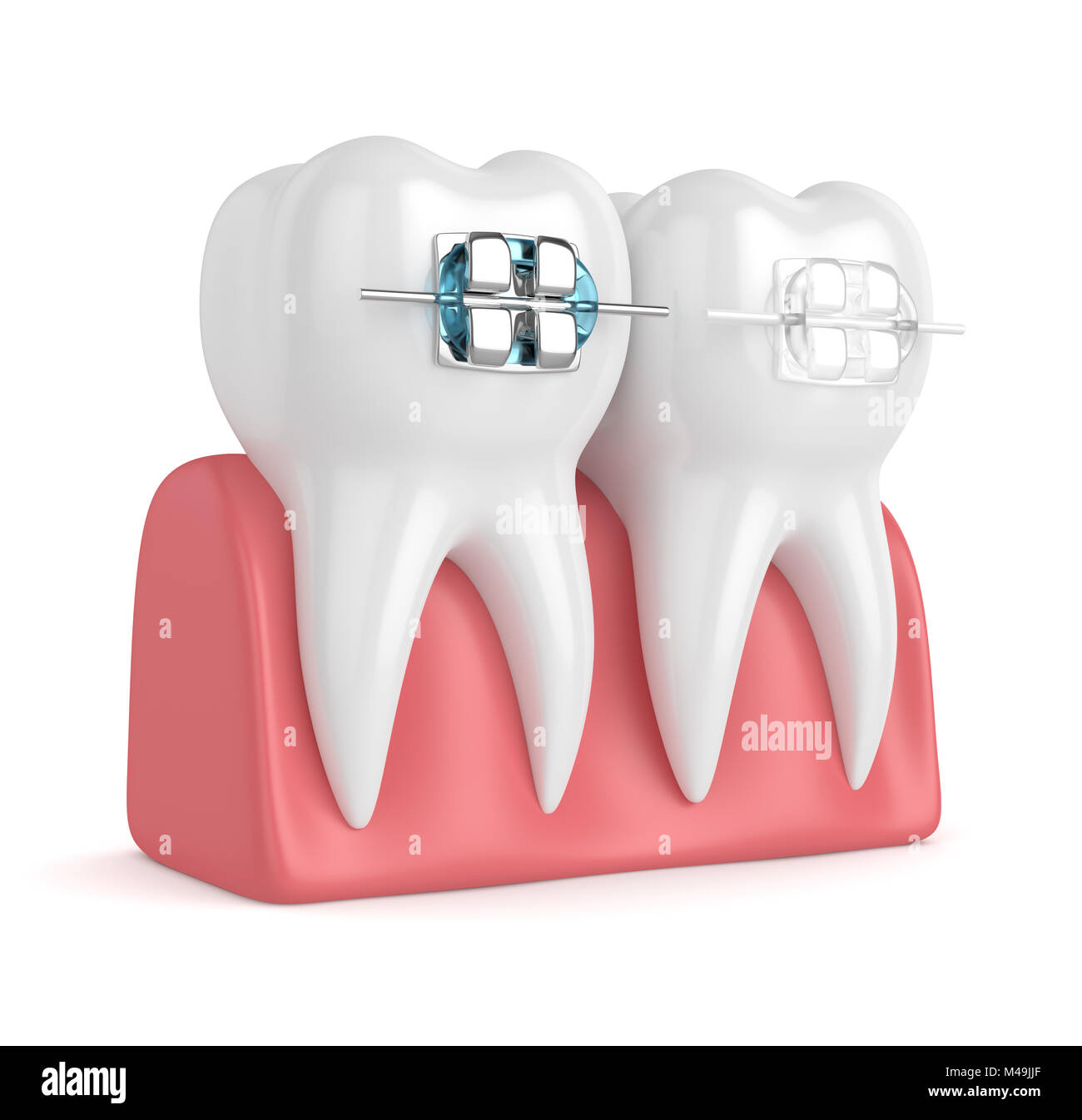3d render of teeth with ceramic and metal braces in gums isolated over ...