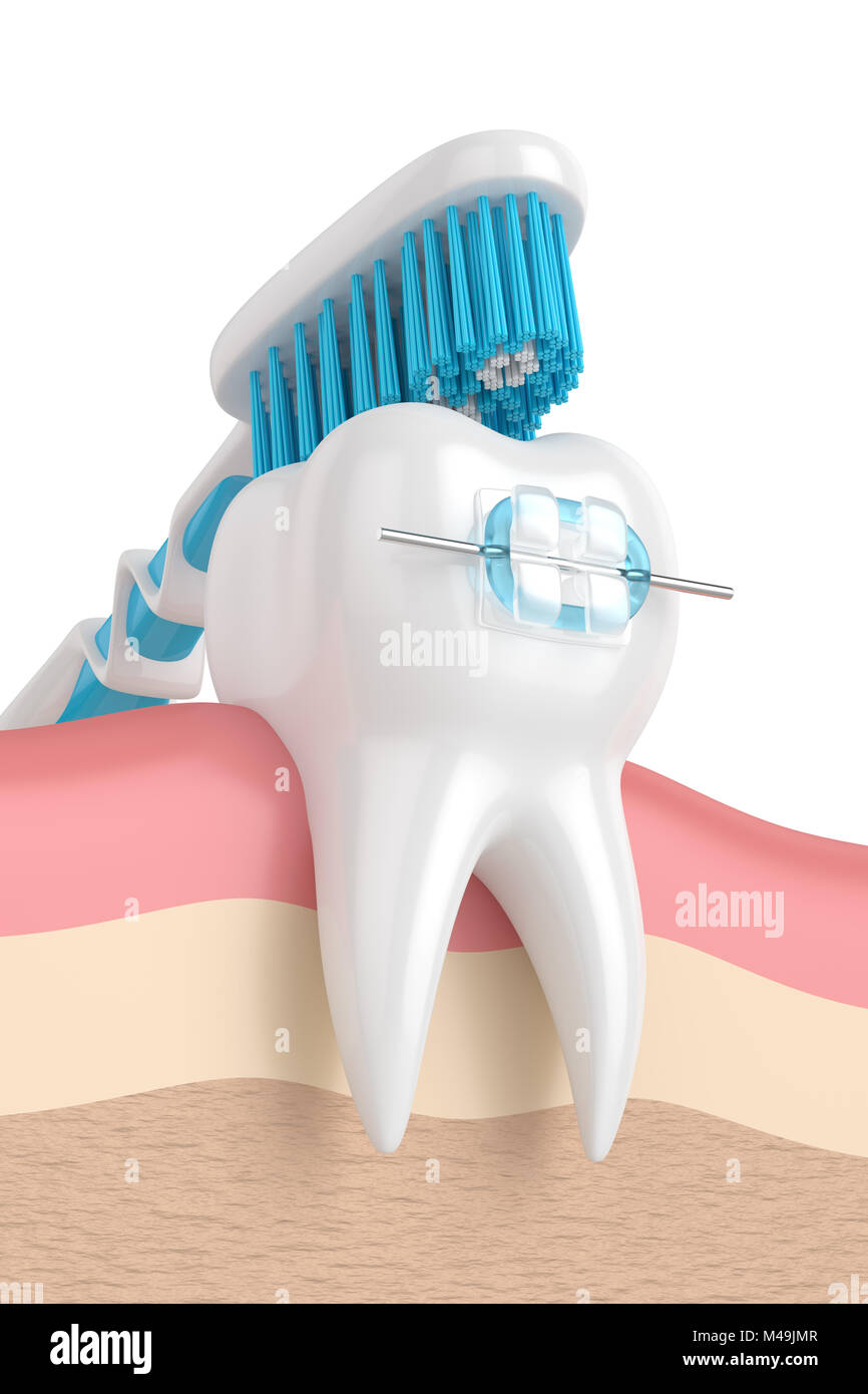 3d render of teeth with ceramic braces and toothbrush in gums Stock ...