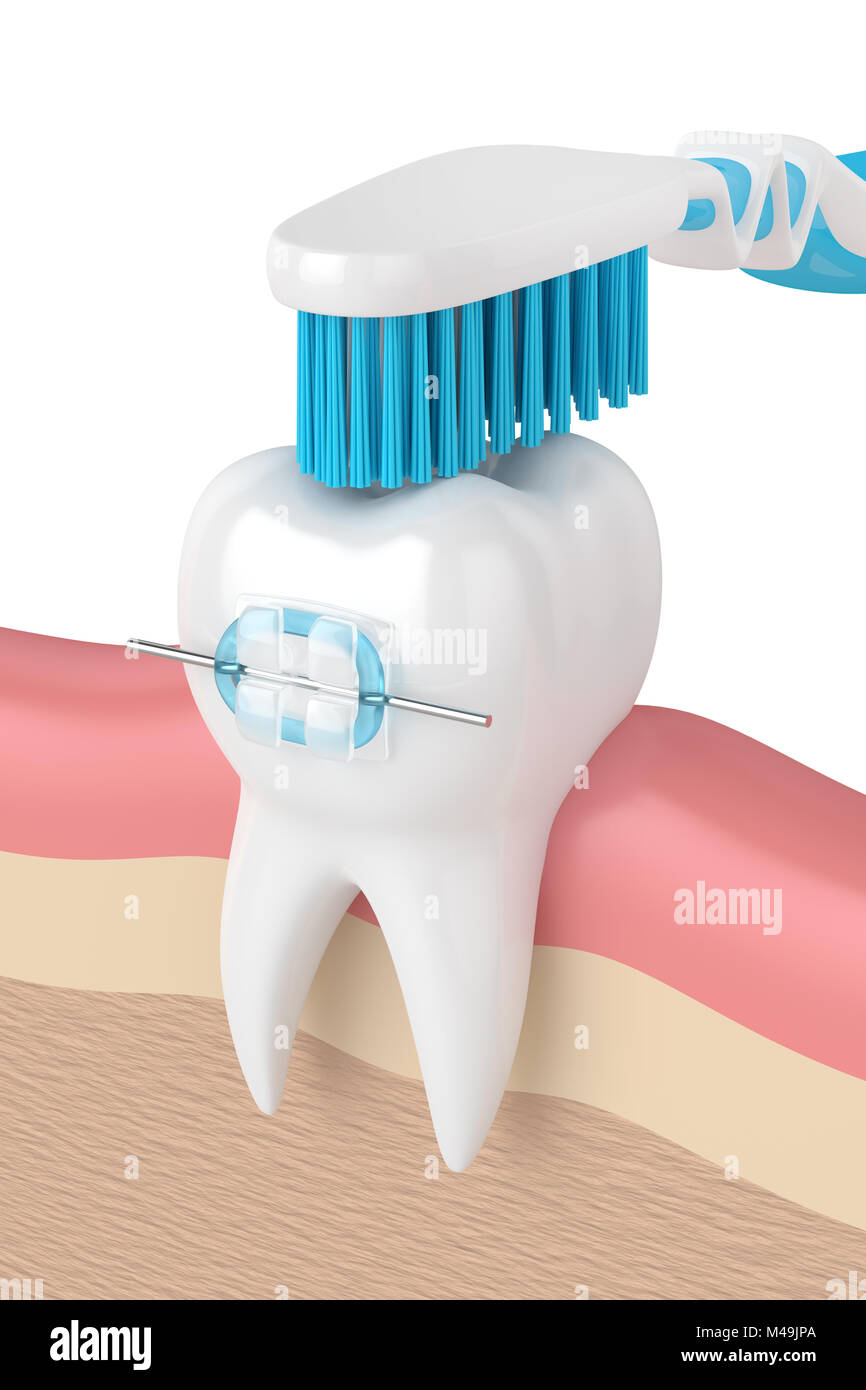 3d render of teeth with ceramic braces and toothbrush in gums Stock ...