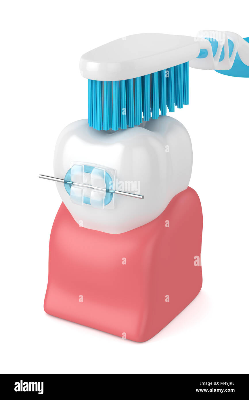 3d render of tooth with ceramic braces and toothbrush isolated over ...