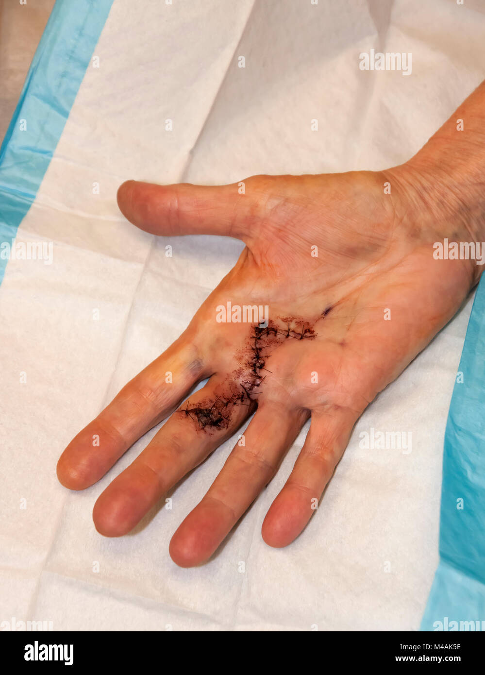 Woman's hand with stitches still in place one month after Dupuytren's Contracture surgery to correct her third finger and palm. Stock Photo